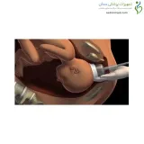 کاپ وکیوم نوزاد