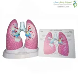 مولاژ سرطان ریه