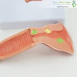 مولاژ بیماری های رحم