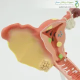 مولاژ بیماری های رحم