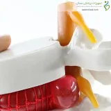 مولاژ دیسک کمر