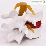 مولاژ دیسک کمر