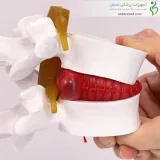 مولاژ دیسک کمر
