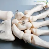 اسکلت مچ دست