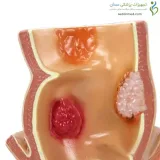 مولاژ رکتوم