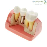 مولاژ ایمپلنت، تاج و بریج دندان