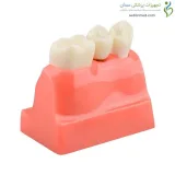 مولاژ ایمپلنت، تاج و بریج دندان