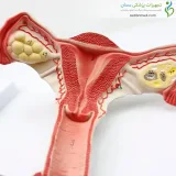 مولاژ رحم و تخمدان