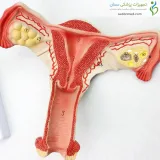 مولاژ رحم و تخمدان