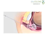 بالن رایپنینگ کوک مدیکال (Cook medical)