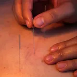 سوزن طب سوزنی دونگ بانگ (DongBang)