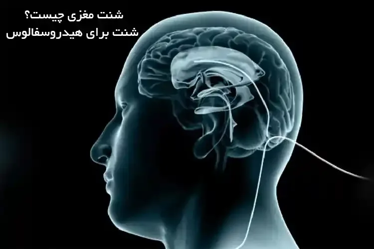 شنت مغزی چیست؟ | شنت برای هیدروسفالوس