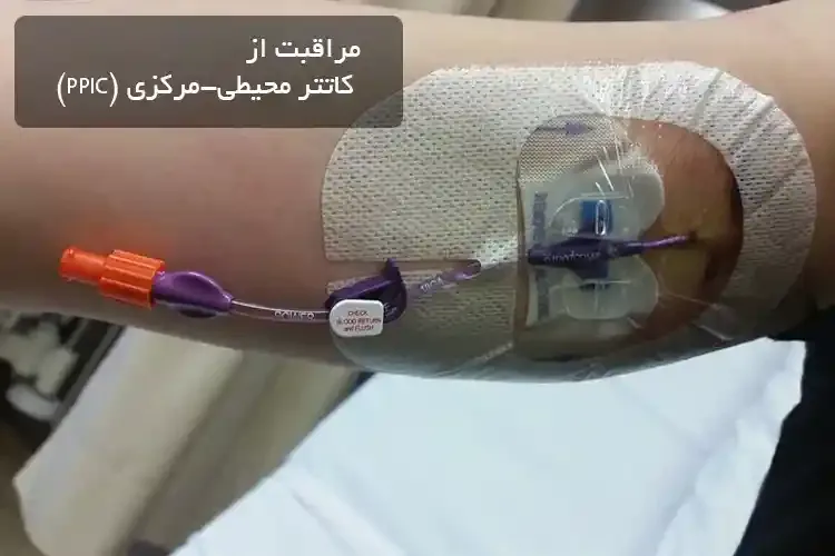 مراقبت از کاتتر محیطی-مرکزی (PPIC)