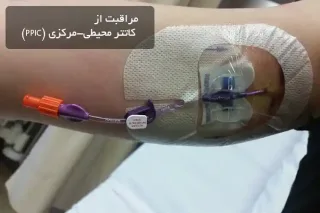مراقبت از کاتتر محیطی-مرکزی (PPIC)