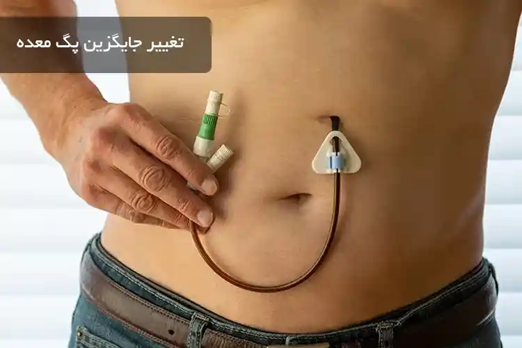 تغییر جایگزین پگ معده
