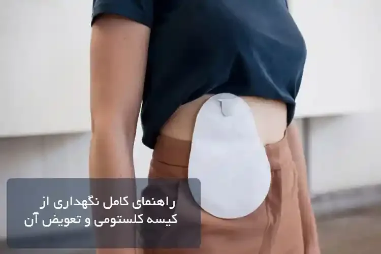 راهنمای کامل نگهداری از کیسه کلستومی و تعویض آن
