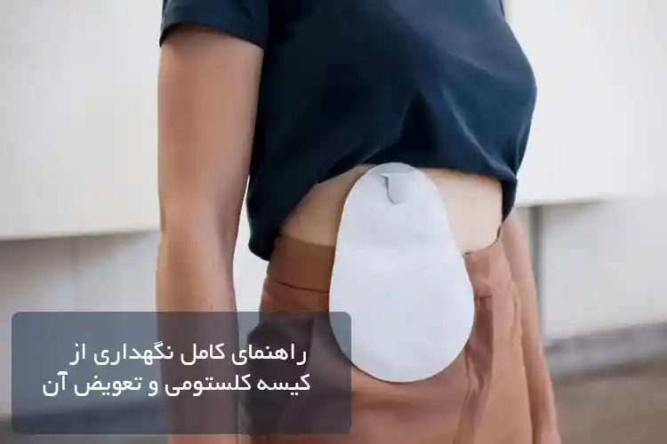 راهنمای کامل نگهداری از کیسه کلستومی و تعویض آن