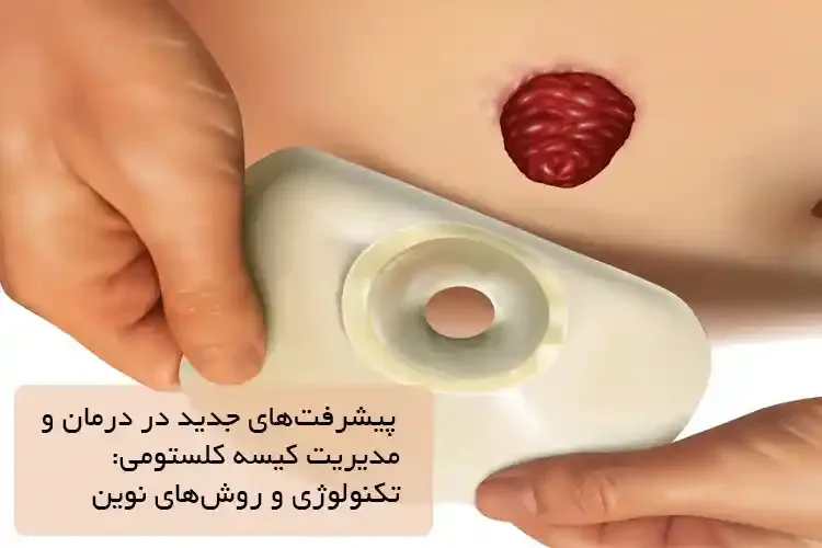 چالش‌ها و مشکلات روزمره زندگی با کیسه کلستومی