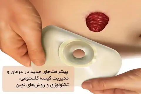 چالشها و مشکلات روزمره زندگی با کیسه کلستومی