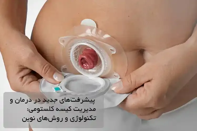 پیشرفت‌های جدید در درمان و مدیریت کیسه کلستومی: تکنولوژی و روش‌های نوین
