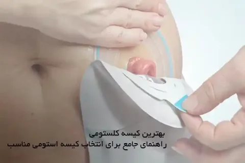 بهترین کیسه کلستومی – راهنمای جامع برای انتخاب کیسه استومی مناسب