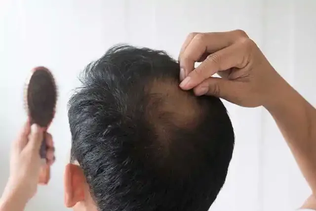 بهترین کلینیک کاشت مو