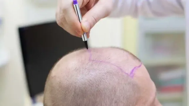 بهترین کلینیک کاشت مو