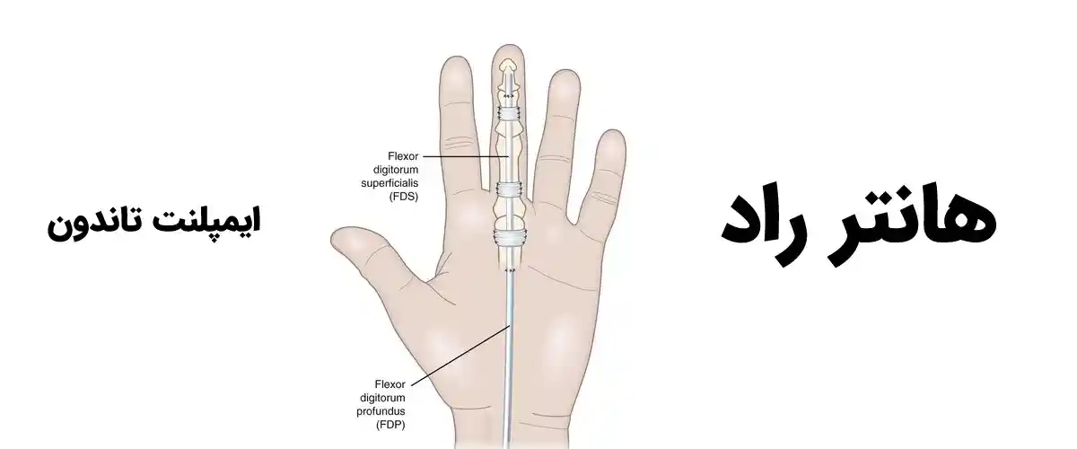 هانتر راد در چه مواردی برای تاندون استفاده می شود؟