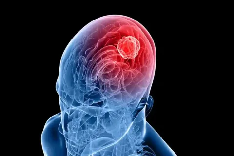 آنتی سیفون مغزی چیست و چه زمانی کاربرد دارد؟