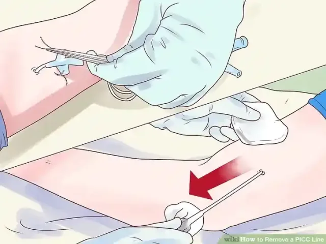 Image titled Remove a PICC Line Step 7