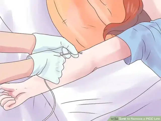 Image titled Remove a PICC Line Step 9