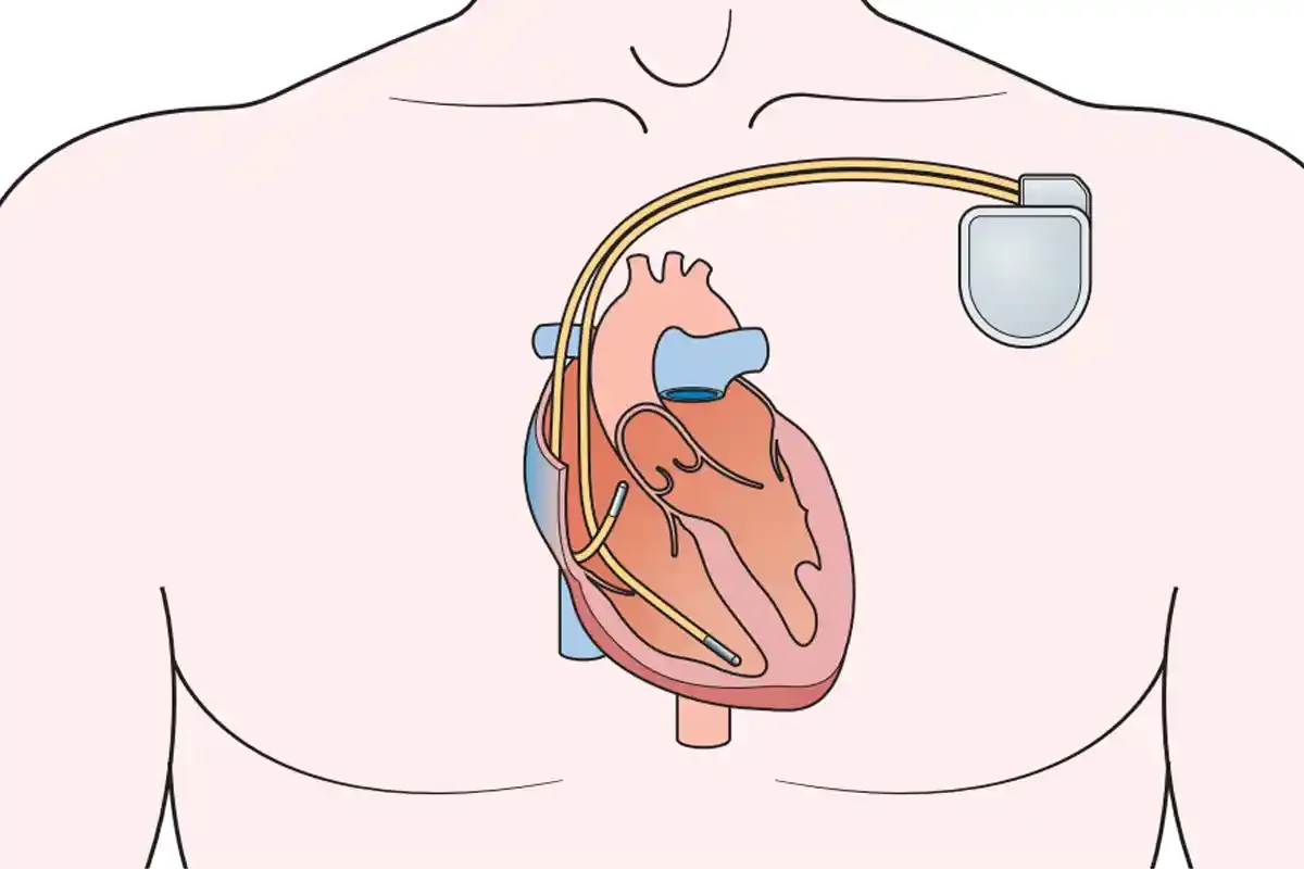 تفاوت پیس میکر و دفیبریلاتور قلبی ایمپلنت پذیر (ICD)