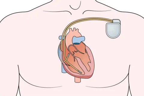 تفاوت پیس میکر و دفیبریلاتور قلبی ایمپلنت پذیر (ICD)
