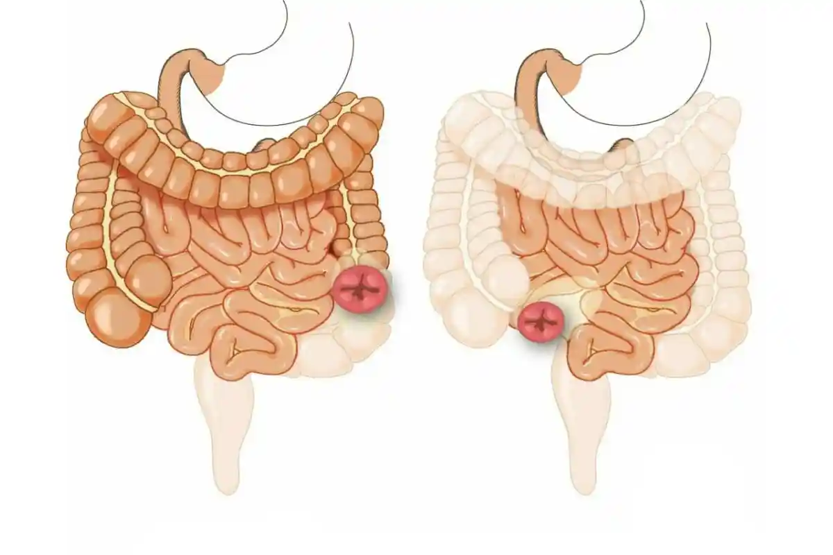 استومی، کلستومی و ایلئوستومی