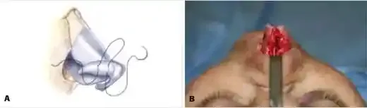 تکنیک بخیه بینی تشکی ساق جانبی