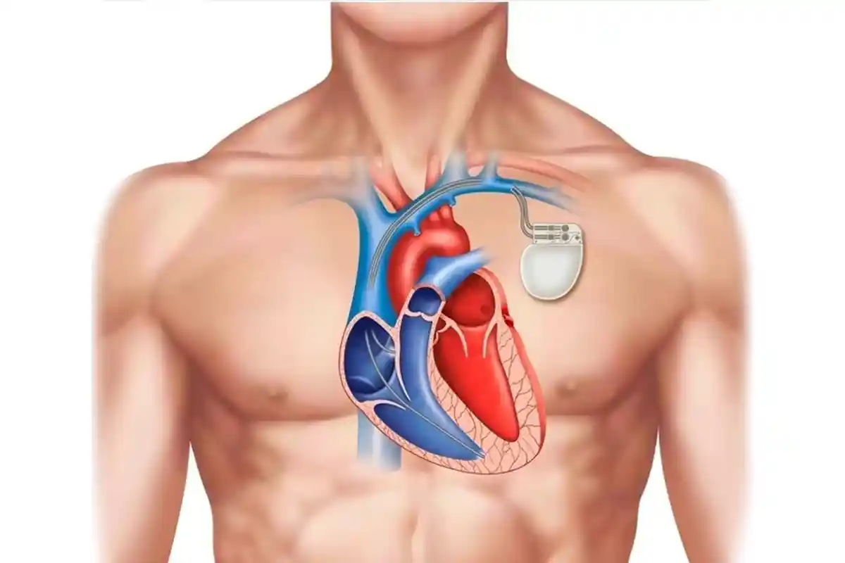 عملکرد پیس میکر