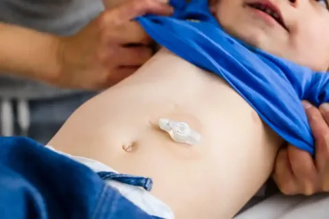 پگ معده PEG
