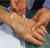 آنژیوکت