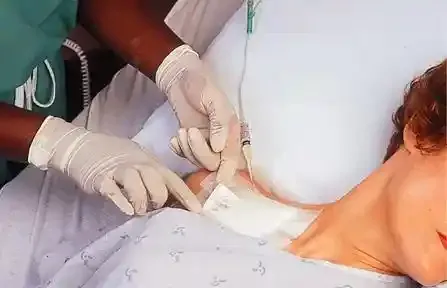 سوند وریدی