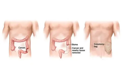 انواع جراحی استومی