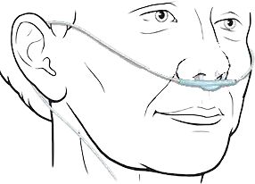 سوند نازال اکسیژن نحوه نصب سوند نازال