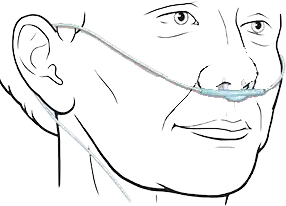 سوند نازال اکسیژن نحوه نصب سوند نازال