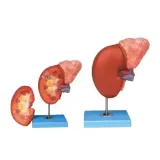 مولاژ کلیه