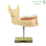 مولاژ آرواره پایین تا 18 سال