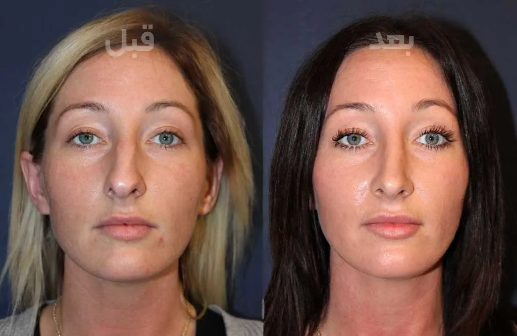 قبل و بعد قرینه سازی بینی