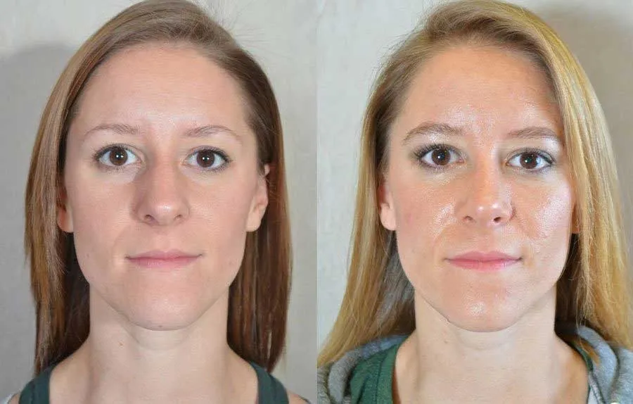 قبل و بعد از قرینه سازی بینی 3