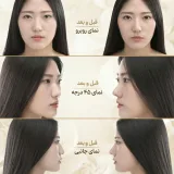 نمای بازسازی بینی توسط فرم دهنده بینی نامرئی مدل 3D Nose Lift مجموعه 3 عددی