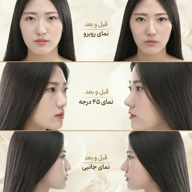 نمای بازسازی بینی توسط فرم دهنده بینی نامرئی مدل 3D Nose Lift مجموعه 3 عددی