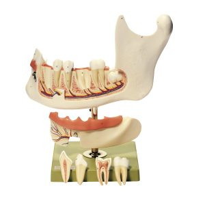 مولاژ آرواره پایین تا 18 سال