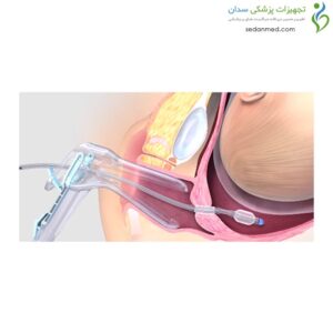 بالن رایپنینگ کوک مدیکال (Cook medical)